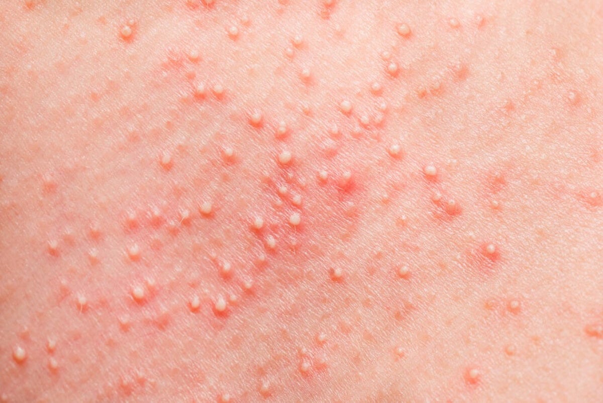 Heat Rash In Adults: Causes, Treatment, And Prevention Tips