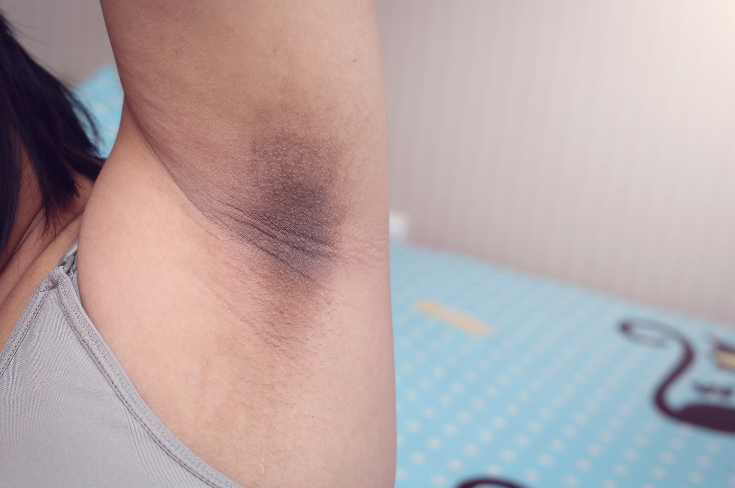 What Causes Dark Underarms and What You Can Do About It